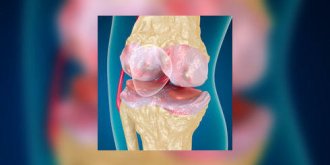 Arthrose : quels traitements ?