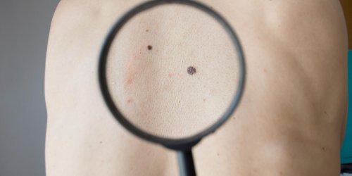 Le cancer de la peau est-il foudroyant ?