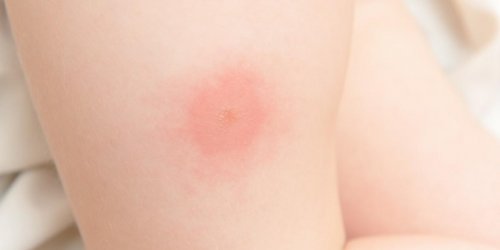 Guepe, moustique : la duree du gonflement en cas de piqure