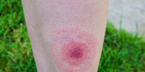 Maladie de Lyme : reconnaitre le premier symptome