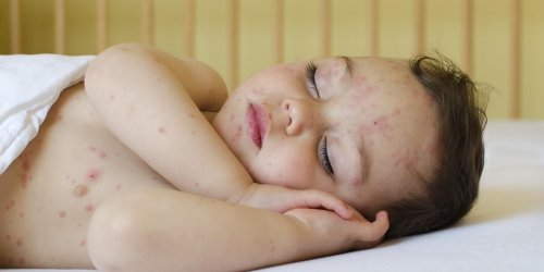 Epidemie de varicelle : les bons reflexes a avoir