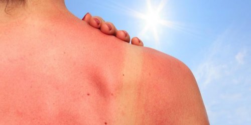 Ultraviolets : les consequences du soleil sur notre peau