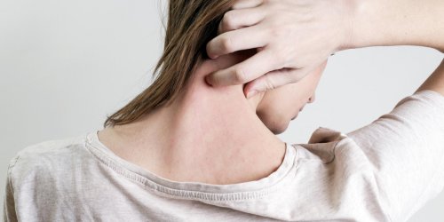 Eczema : ce qui soulage les demangeaisons