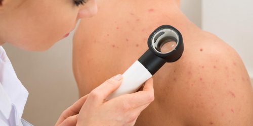 Cancer de la peau : les pharmaciens veulent se joindre au depistage