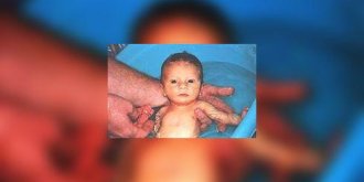 Eczéma : trop d'hygiène ?