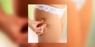 En finir avec la cellulite