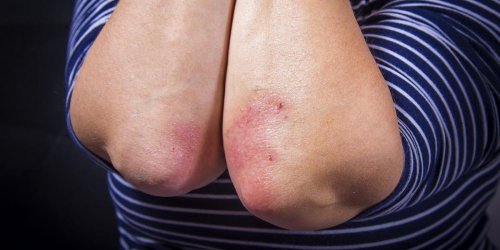Psoriasis : la maladie de peau la plus genante pour les Francais
