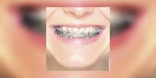 Orthodontie : les appareils dentaires « faits maison » sont a proscrire