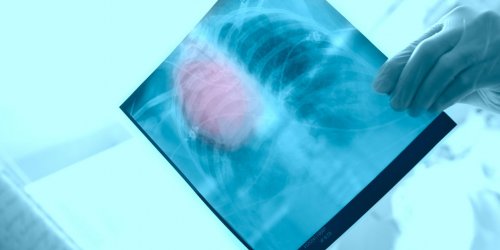 Tuberculose : un cas se declare dans un lycee des Landes