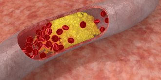 Atherosclerose : la maladie qui touche les 40-54 ans