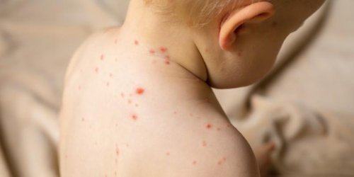 La varicelle progresse dans plusieurs regions de France