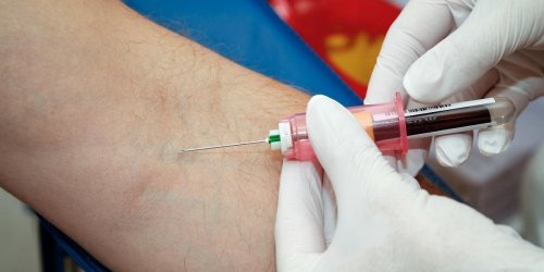 Un test sanguin capable de detecter le melanome a un stade precoce