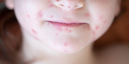 Plusieurs regions touchees par une epidemie de varicelle 