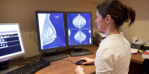 Un cancer du sein avance gueri grace a une therapie stimulant le systeme immunitaire