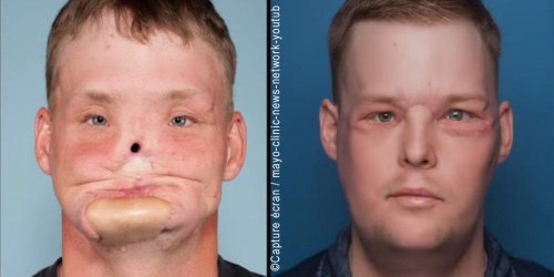 Greffe du visage : defigure, un Americain retrouve un visage normal