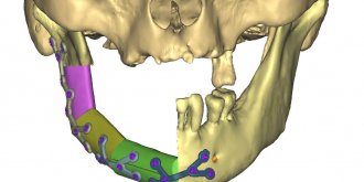 Lyon : des chirurgiens utilisent la 3D pour reconstruire une machoire