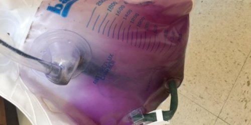 Des patients hospitalises ont une urine violette