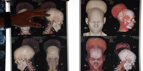 Un homme opere d’une tumeur cerebrale de pres de 2 kilos