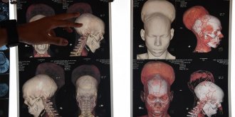 Un homme opere d’une tumeur cerebrale de pres de 2 kilos