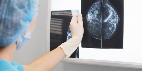 Cancer du sein metastase : mieux vaudrait eviter le palbociclib (Ibrance®) 