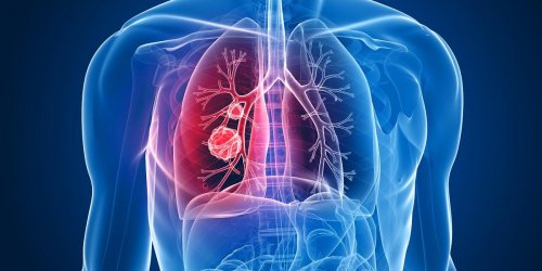 Cancer du poumon : il serait possible de se passer de chimiotherapie