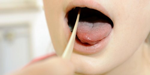 Un nouveau cas de maladie de la langue noire chevelue rapportee par un medecin