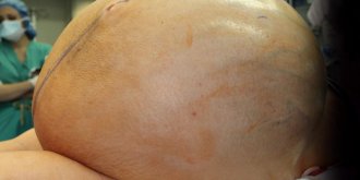 Une femme operee pour une tumeur aux ovaires de 60 kilos !