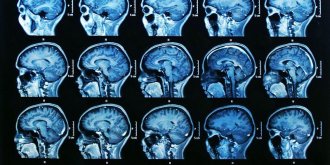 Et si le stress reduisait la taille du cerveau ?