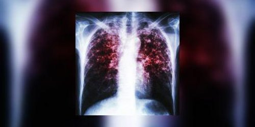 Tuberculose : bientot un test respiratoire ? 