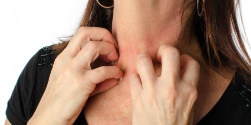 Pourquoi l-eczema recidive : l-Inserm nous explique enfin
