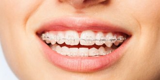 Les appareils orthodontiques, nids a bacteries dans la bouche ?