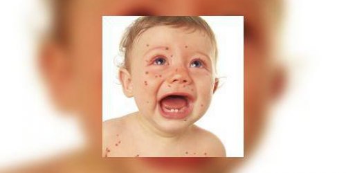 Epidemie de rougeole : verifiez vos vaccins ! 