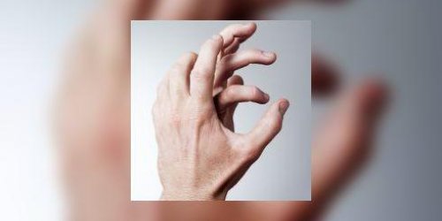 Deformation des doigts