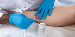 La maladie de Verneuil et le cancer de la peau sont-ils en lien ?