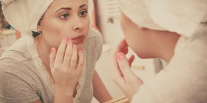 Acne : quand passer aux medicaments ?