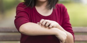 3 astuces pour soulager rapidement une urticaire
