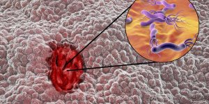 Ulcere de l-estomac et Helicobacter pylori : quels traitements ?
