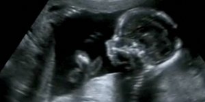 Une petite fille nait avec ses organes a l’exterieur de son corps