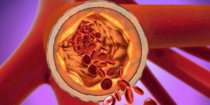 Statine : un medicament qui reduit l-exces de cholesterol