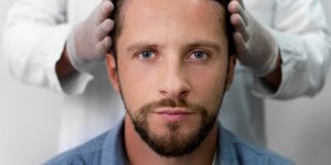 Perte de cheveux : les motivations derriere le choix des implants capillaires