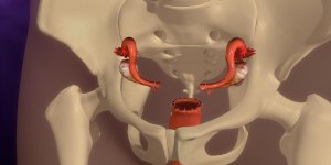 Ablation de l-uterus : l-hysterectomie, une methode de sterilisation feminine ?