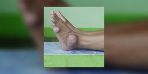 Crise de goutte : quels symptomes, quelles causes ?