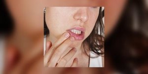 Herpes, c-est toujours le meme scenario 