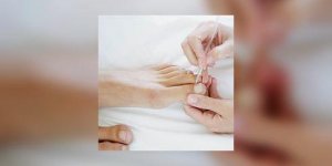 Comment venir a bout de ces cors et durillons qui nous cassent les pieds ?