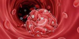 Thrombose veineuse : des facteurs de risque identifies chez la femme