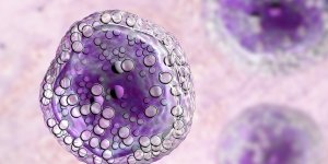 Le lymphome, un cancer du sang difficile a diagnostiquer