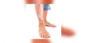Vitiligo : quand la peau perd sa couleur