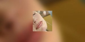 Rajeunissement du visage : apres le lifting, les fils de suspension 
