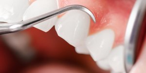 Gencive blanche : les traitements contre les abces