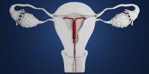 Contraception : trois sterilets suspendus par l’ANSM
